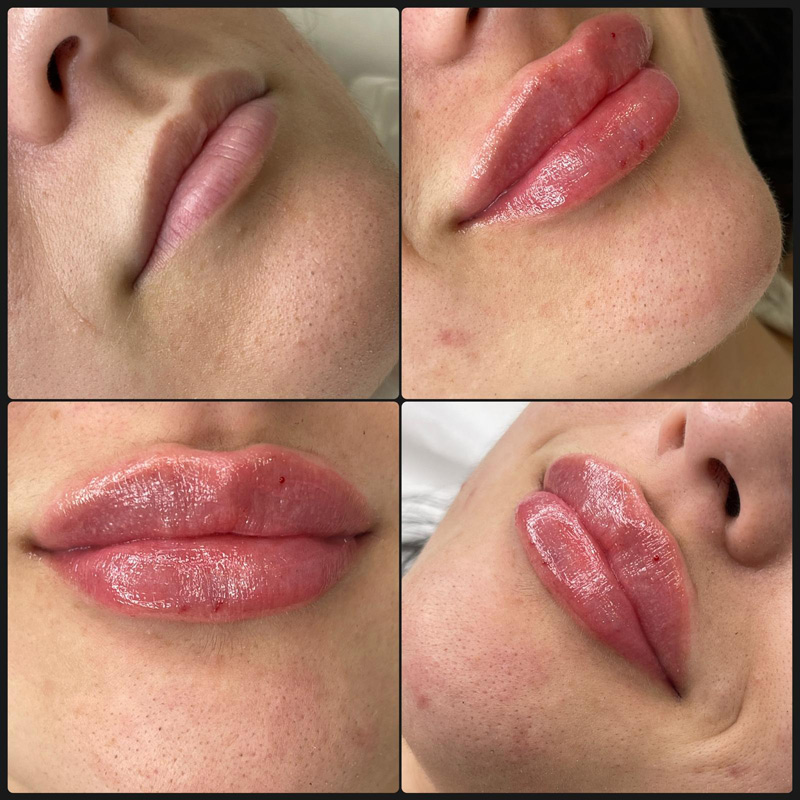 Fillers in Romford | Nevi Hair and Aesthetics gallery image 3