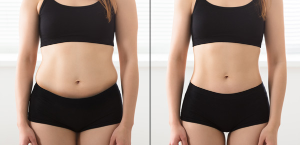 Woman before and after fat reduction treatment