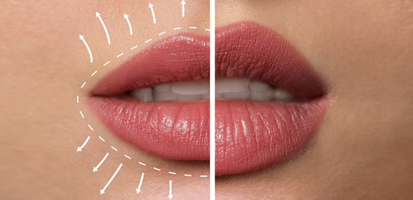 Before and after of lip fillers