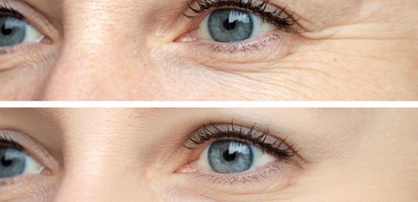 Before and after wrinkle treatment