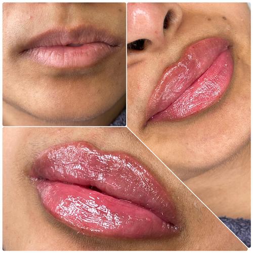 Collage of lip fillers