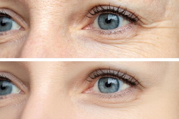 Woman before and after wrinkle treatment