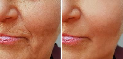 Before and after smile line filler