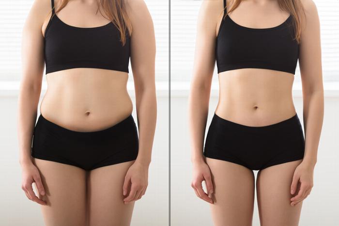 Woman before and after fat reduction treatment 